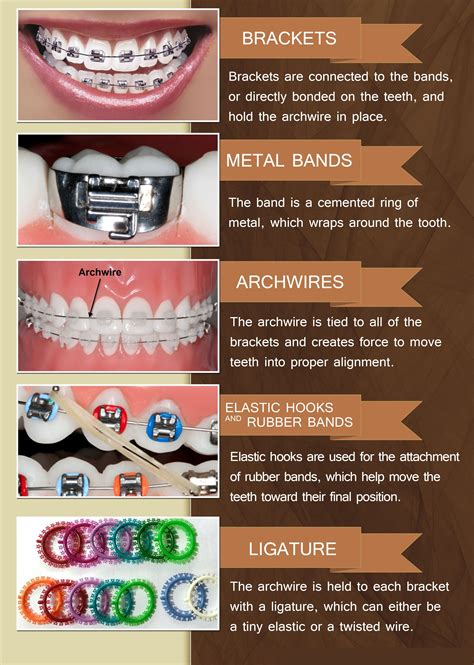 types of braces for brackets